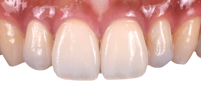 イメージ:関口デンタルオフィス埼玉の審美治療