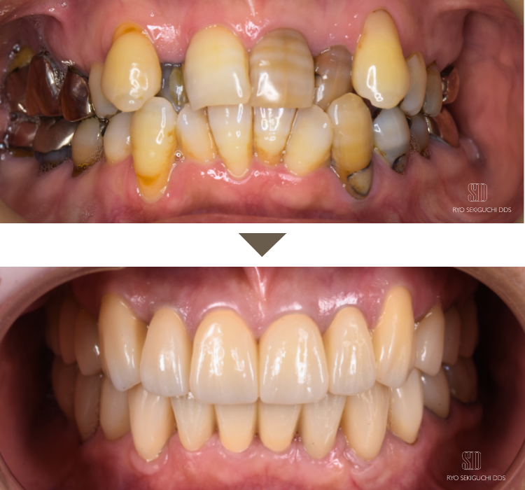 全顎インプラント症例