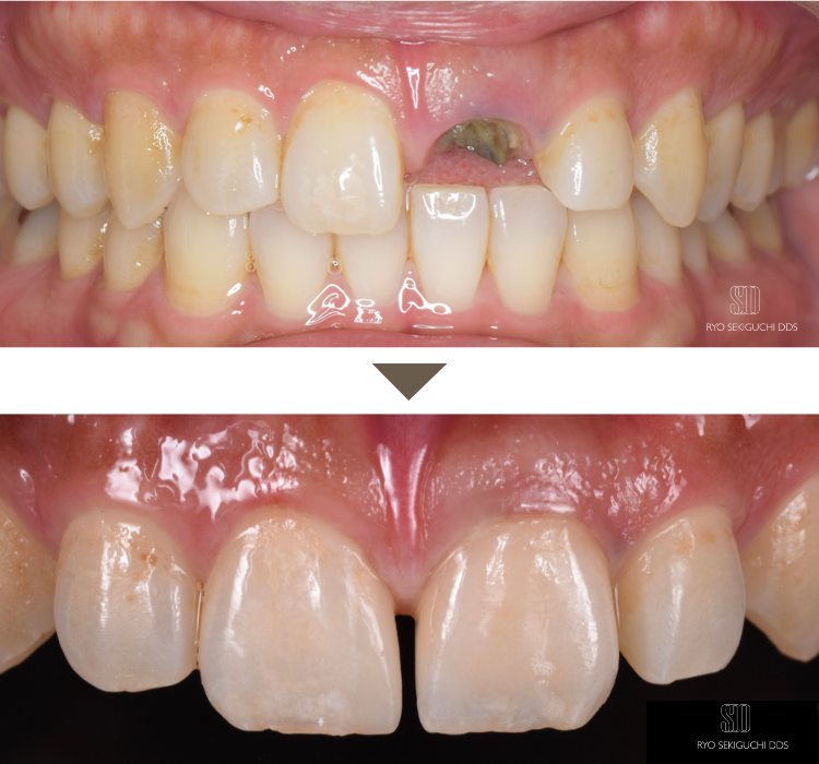 前歯インプラント症例