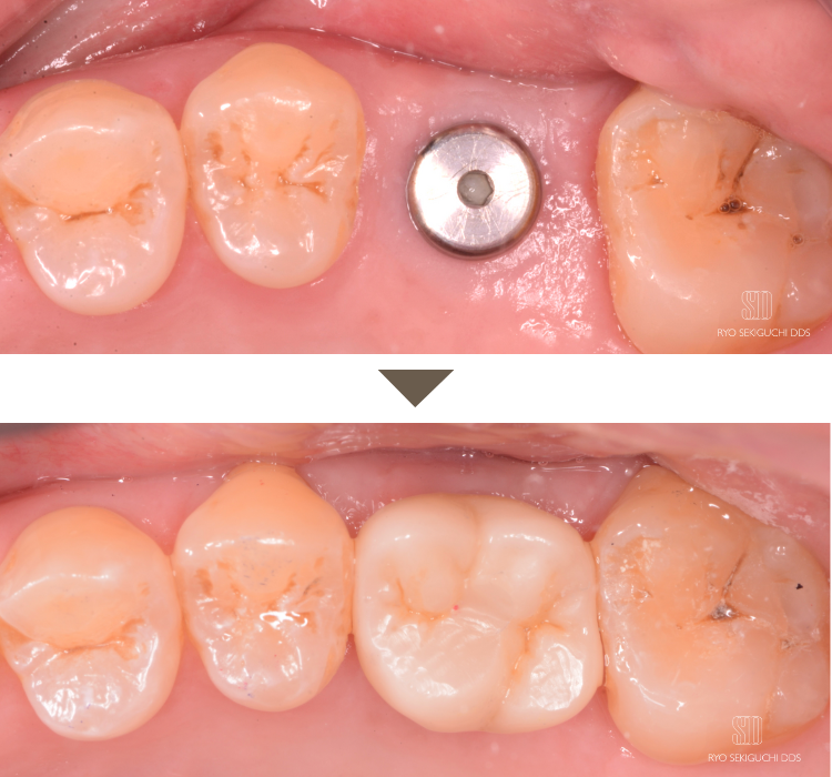 臼歯インプラント症例